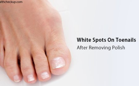 Nail White Spots After Polish Remover: What They Mean & How to Fix Them