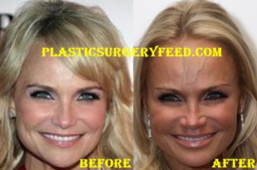 Kristin Chenoweth & Plastic Surgery: What’s the Truth?