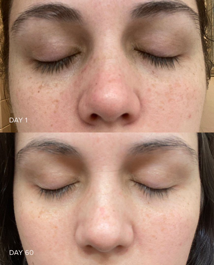 Vitamin C Serum Before & After: Real Results & Skincare Benefits